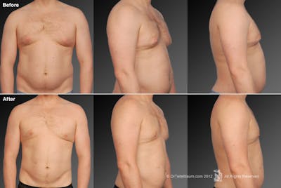 Liposuction Before & After Gallery - Patient 106041497 - Image 1