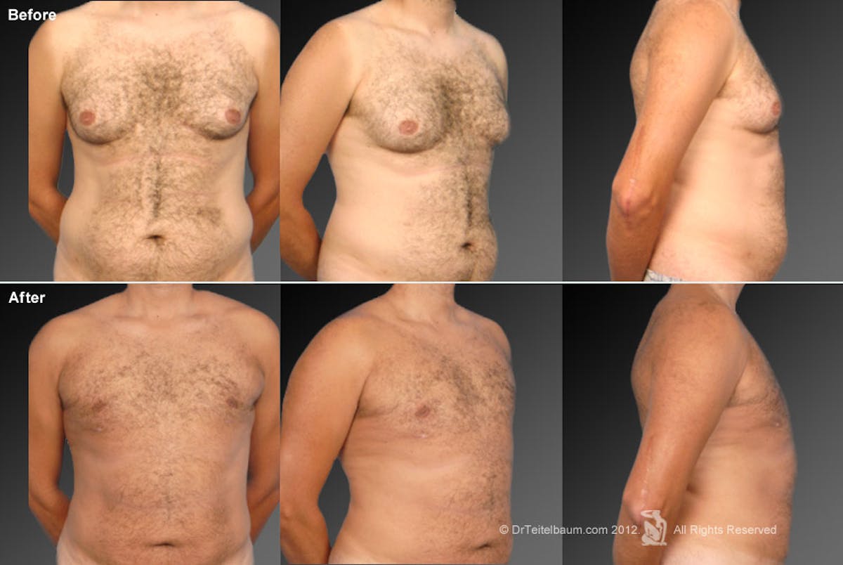 Liposuction Before & After Gallery - Patient 106041498 - Image 1