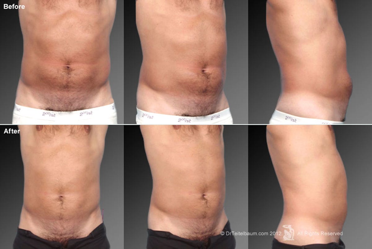 Liposuction Before & After Gallery - Patient 106041499 - Image 1