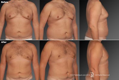 Liposuction Before & After Gallery - Patient 106041500 - Image 1