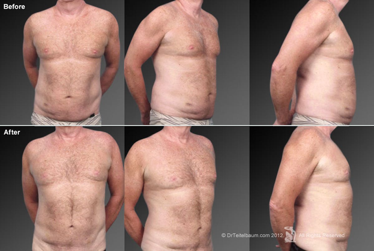 Liposuction Before & After Gallery - Patient 106041501 - Image 1