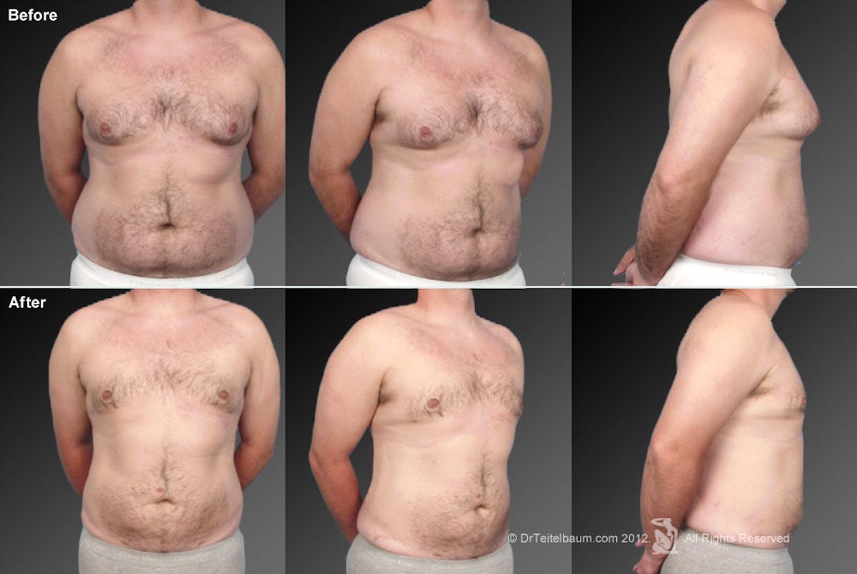 Liposuction Before & After Gallery - Patient 106041502 - Image 1