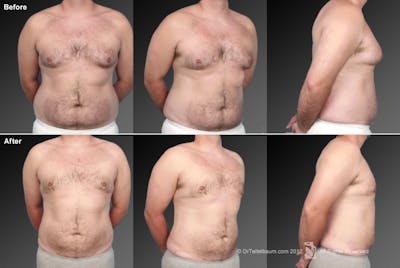 Liposuction Before & After Gallery - Patient 106041502 - Image 1