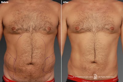 Liposuction Before & After Gallery - Patient 106041503 - Image 1