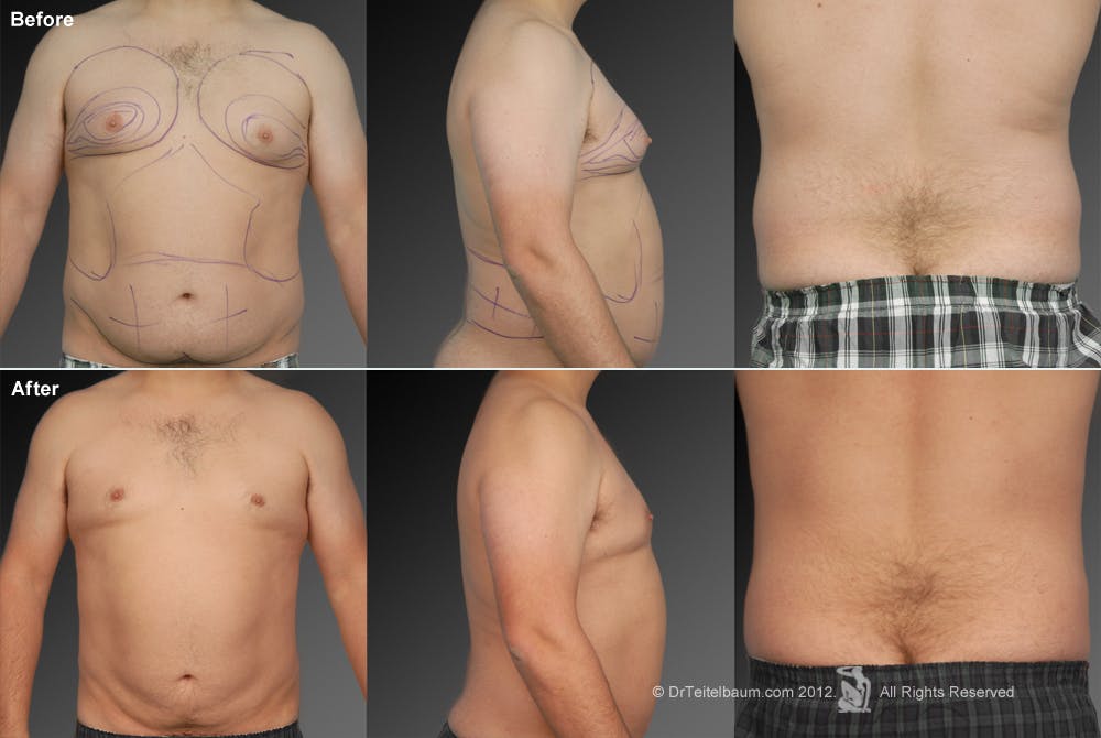 Liposuction Before & After Gallery - Patient 106041504 - Image 1