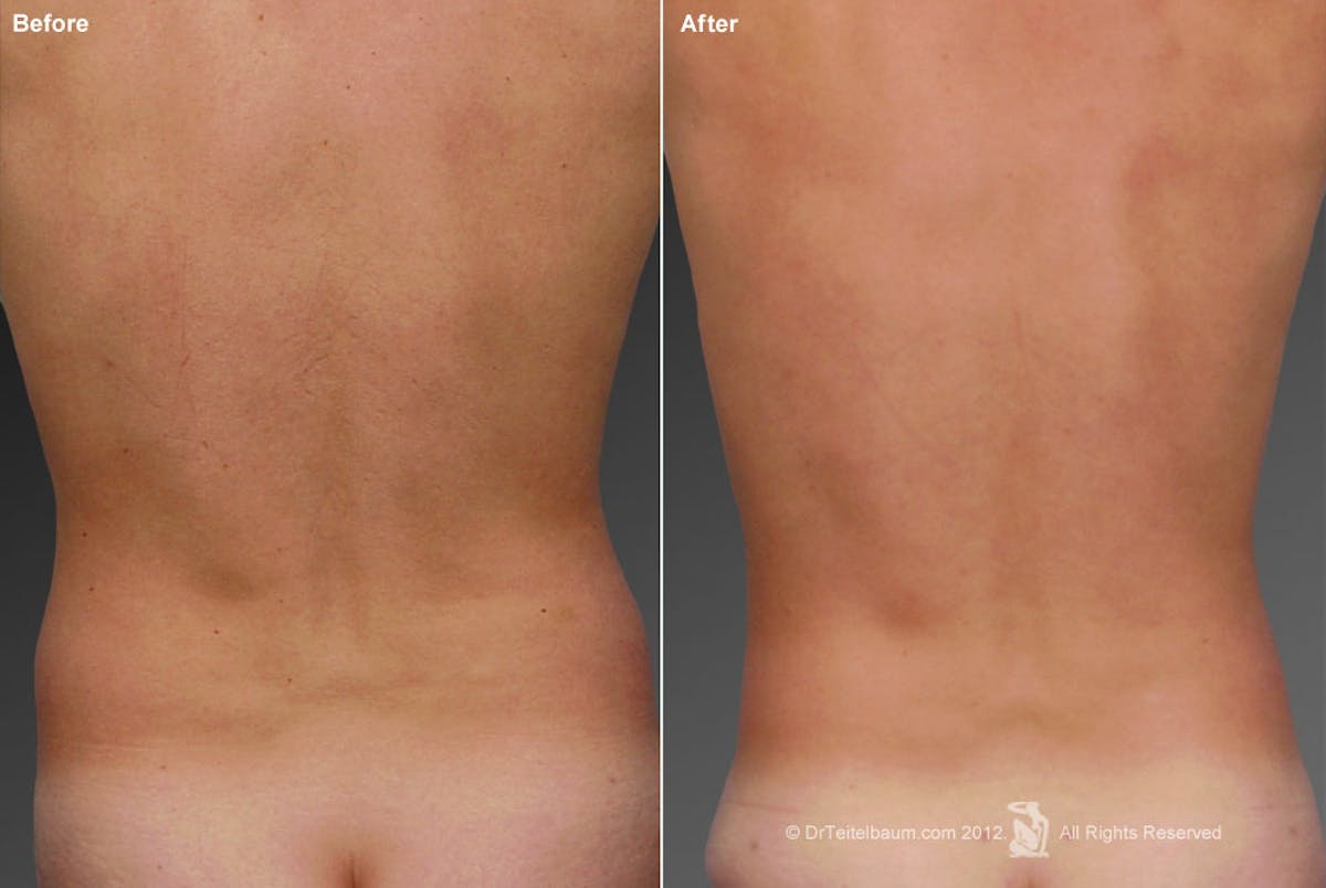 Liposuction Before & After Gallery - Patient 106041505 - Image 1