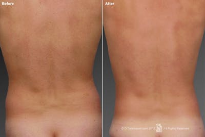 Liposuction Before & After Gallery - Patient 106041505 - Image 1