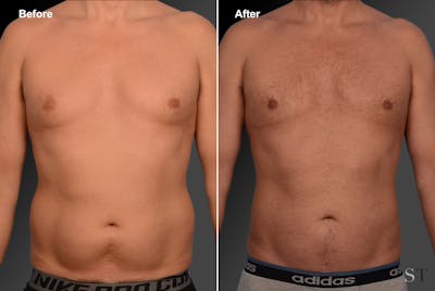 Liposuction Before & After Gallery - Patient 106041548 - Image 1
