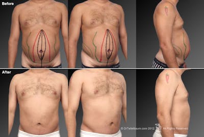 Tummy Tuck Before & After Gallery - Patient 106041552 - Image 1