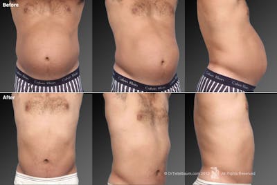 Tummy Tuck Before & After Gallery - Patient 106041553 - Image 1