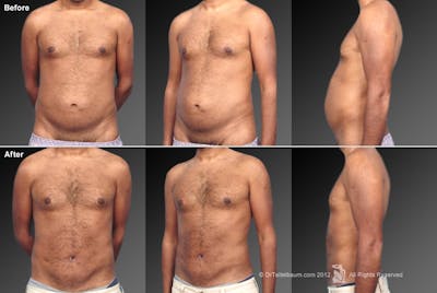 Tummy Tuck Before & After Gallery - Patient 106041555 - Image 1