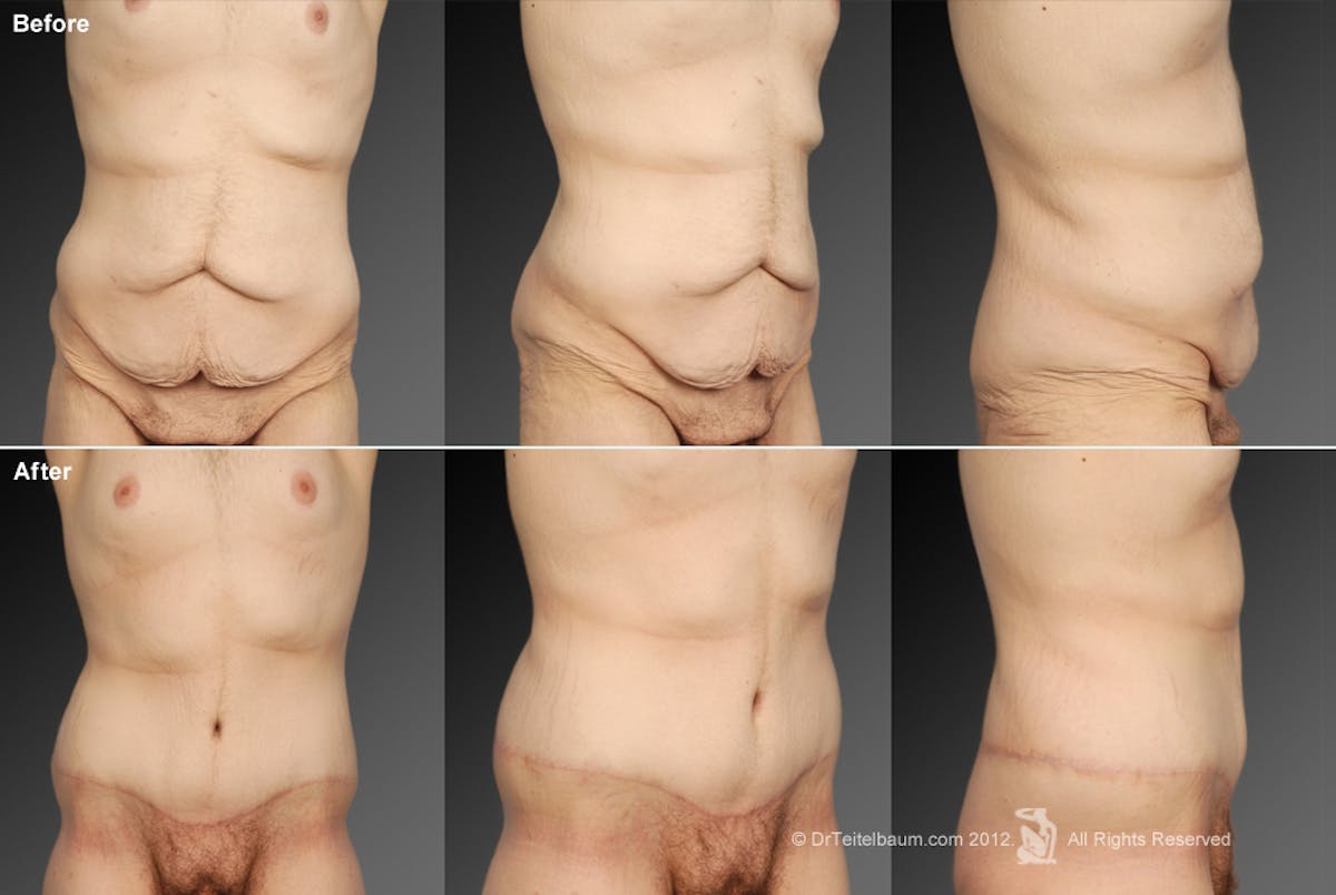 Tummy Tuck Before & After Gallery - Patient 106041557 - Image 1