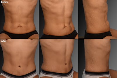 Tummy Tuck Before & After Gallery - Patient 106041558 - Image 1