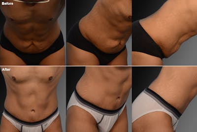 Tummy Tuck Before & After Gallery - Patient 106041560 - Image 1