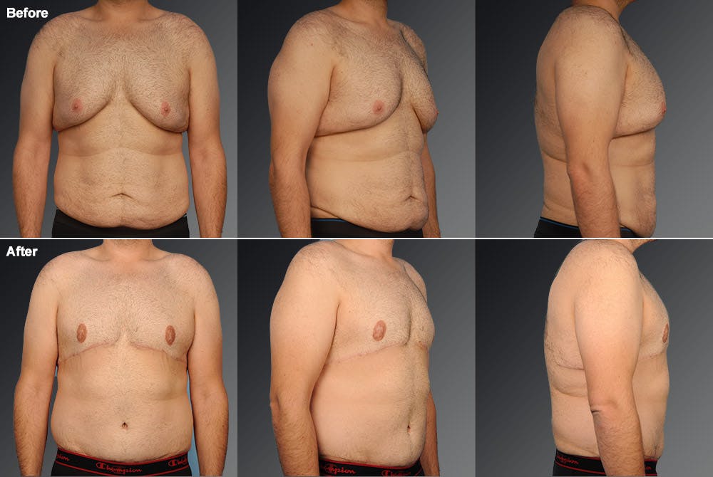 Tummy Tuck Before & After Gallery - Patient 106041563 - Image 1