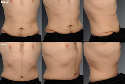 Tummy Tuck Before & After Gallery - Patient 106041567 - Image 1
