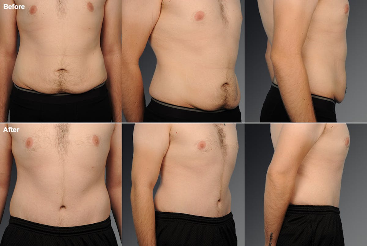 Tummy Tuck Before & After Gallery - Patient 106041568 - Image 1