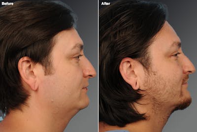 Face Before & After Gallery - Patient 106041585 - Image 1