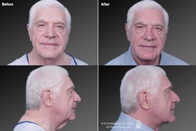 Face Before & After Gallery - Patient 106041586 - Image 1