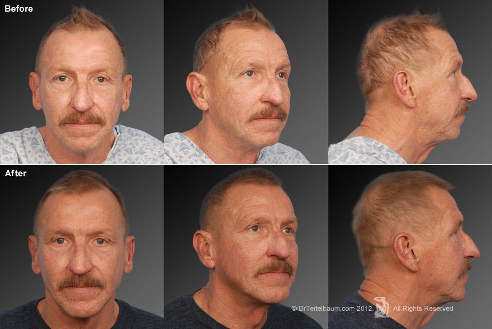 Face Before & After Gallery - Patient 106041589 - Image 1