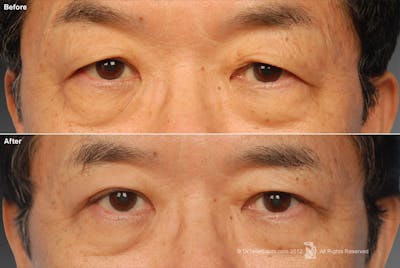 Face Before & After Gallery - Patient 106041592 - Image 1