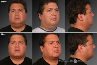 Face Before & After Gallery - Patient 106041594 - Image 1
