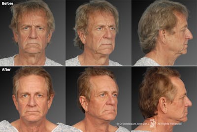 Face Before & After Gallery - Patient 106041595 - Image 1