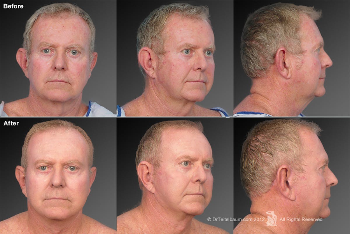Face Before & After Gallery - Patient 106041596 - Image 1