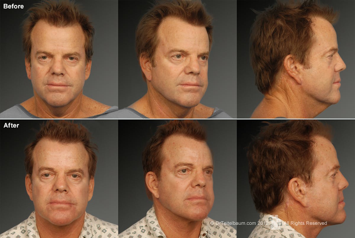 Face Before & After Gallery - Patient 106041603 - Image 1