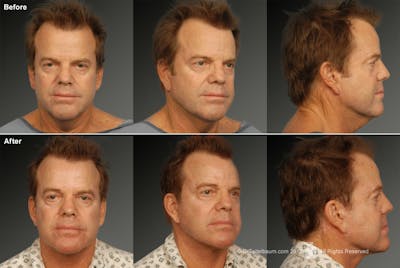 Face Before & After Gallery - Patient 106041603 - Image 1