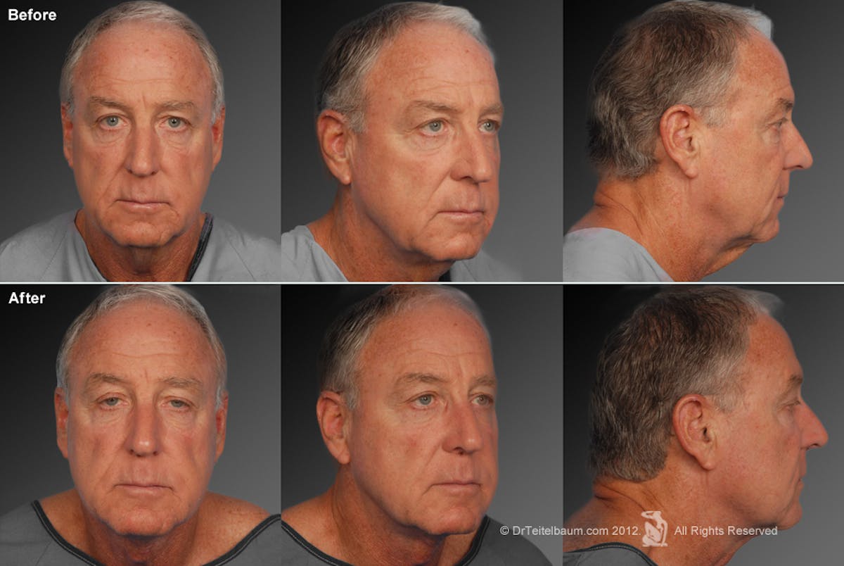 Face Before & After Gallery - Patient 106041605 - Image 1