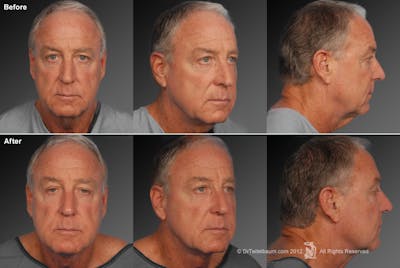 Face Before & After Gallery - Patient 106041605 - Image 1