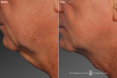 Face Before & After Gallery - Patient 106041606 - Image 1