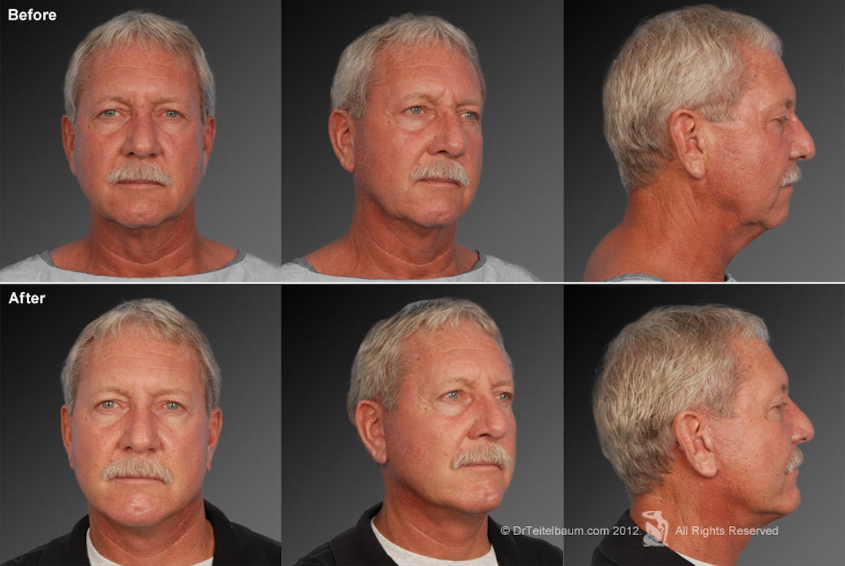 Face Before & After Gallery - Patient 106059607 - Image 1