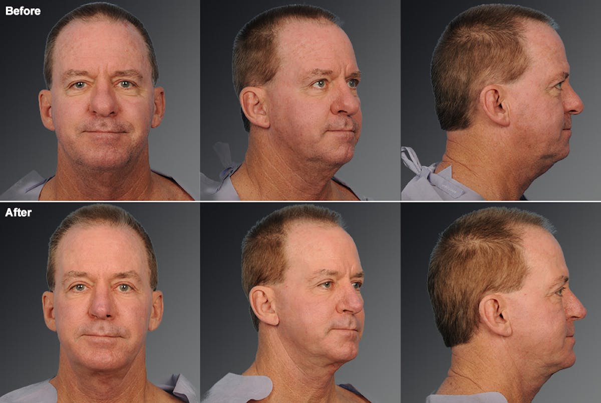 Face Before & After Gallery - Patient 106098614 - Image 1