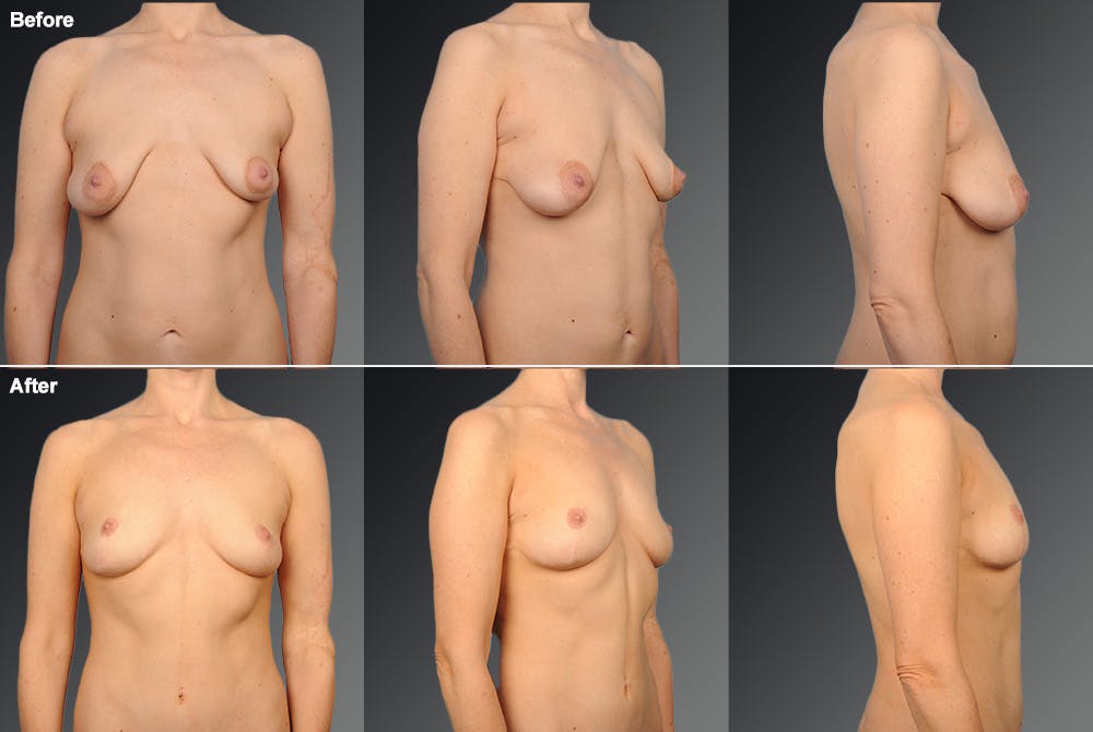 Breast Lift (Mastopexy) Before & After Gallery - Patient 106358471 - Image 1