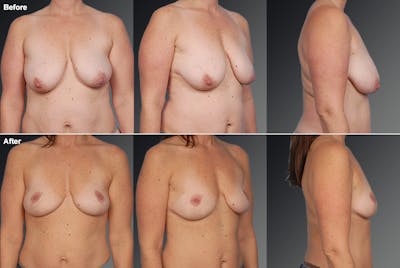 Breast Lift (Mastopexy) Before & After Gallery - Patient 106358472 - Image 1