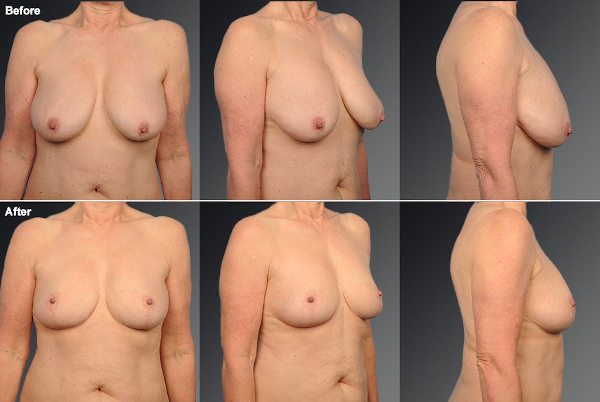 Breast Lift (Mastopexy) Before & After Gallery - Patient 106358475 - Image 1