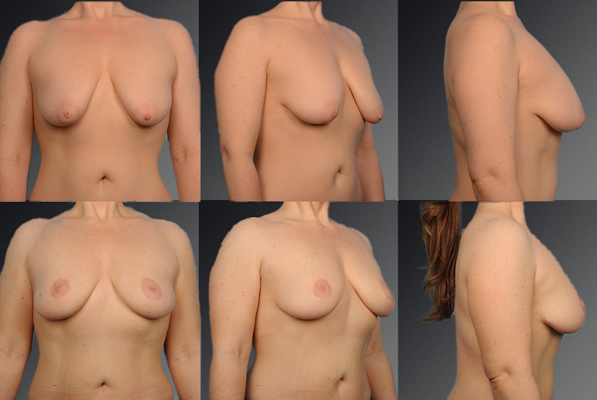 Breast Lift (Mastopexy) Before & After Gallery - Patient 106358477 - Image 1