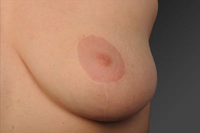 Breast Lift (Mastopexy) Before & After Gallery - Patient 106358482 - Image 1