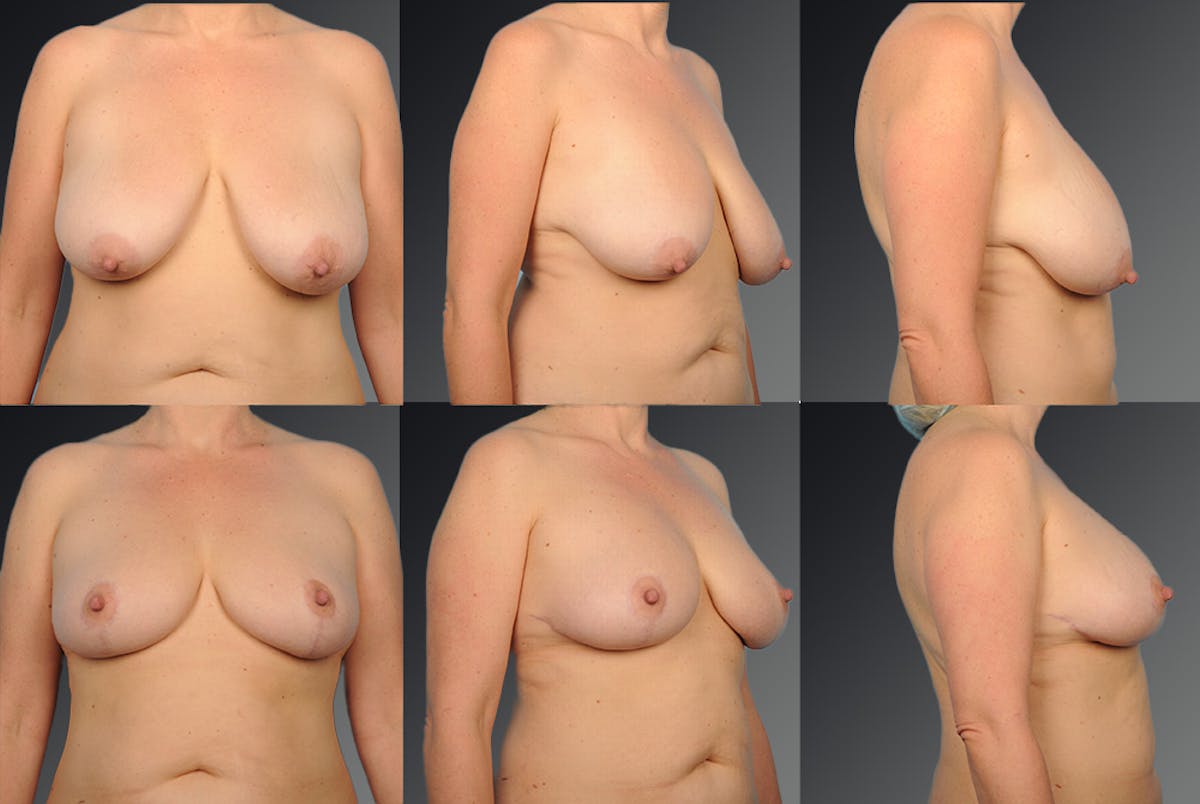 Breast Lift (Mastopexy) Before & After Gallery - Patient 106358483 - Image 1