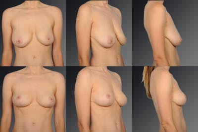 Breast Lift (Mastopexy) Before & After Gallery - Patient 106358485 - Image 1