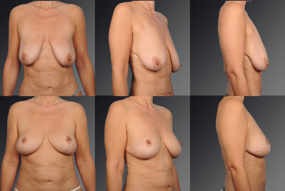 Breast Lift (Mastopexy) Before & After Gallery - Patient 106358486 - Image 1