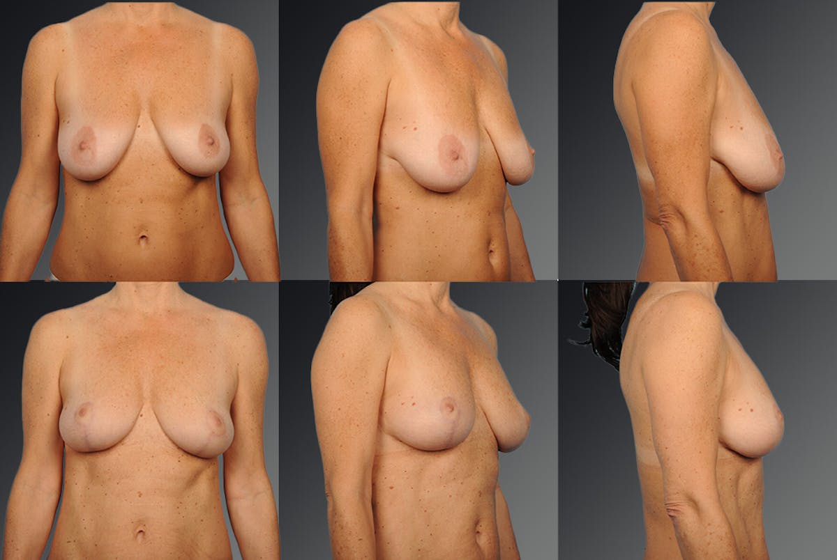 Breast Lift (Mastopexy) Before & After Gallery - Patient 106358487 - Image 1