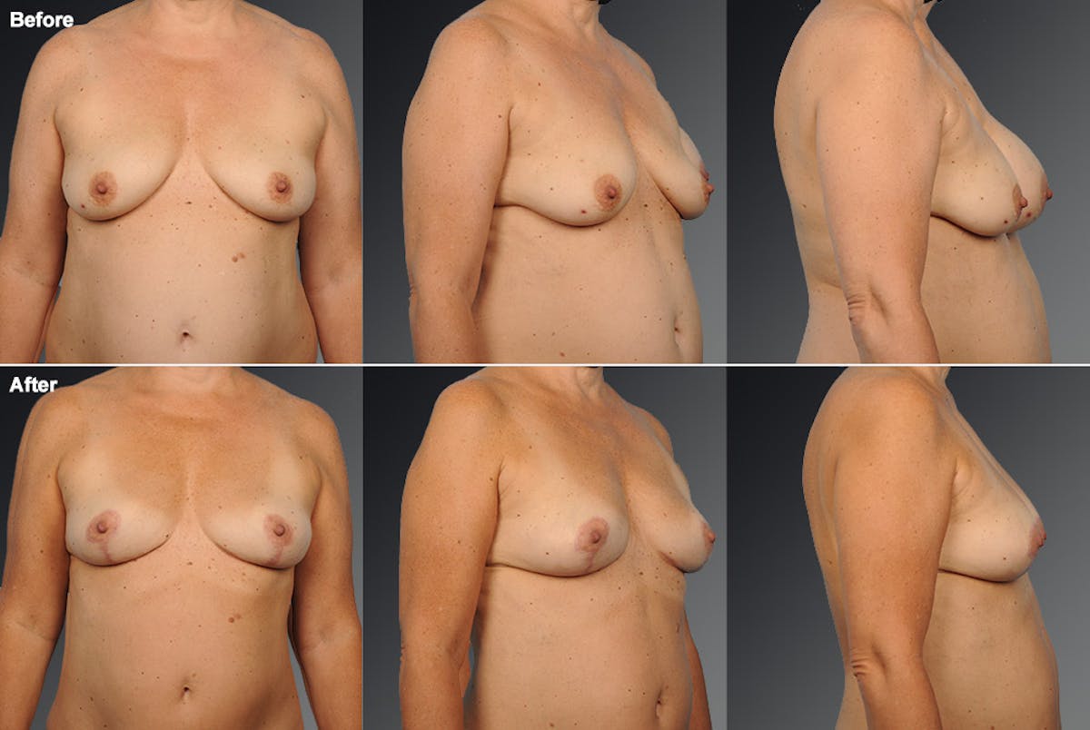 Breast Lift (Mastopexy) Before & After Gallery - Patient 106358491 - Image 1