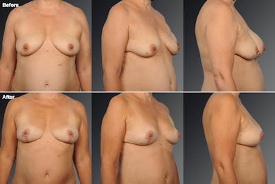 Breast Lift (Mastopexy) Before & After Gallery - Patient 106358491 - Image 1