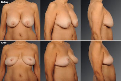 Breast Lift (Mastopexy) Before & After Gallery - Patient 106358496 - Image 1