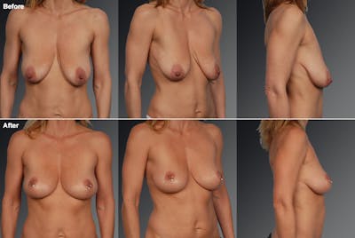 Breast Lift (Mastopexy) Before & After Gallery - Patient 106358497 - Image 1