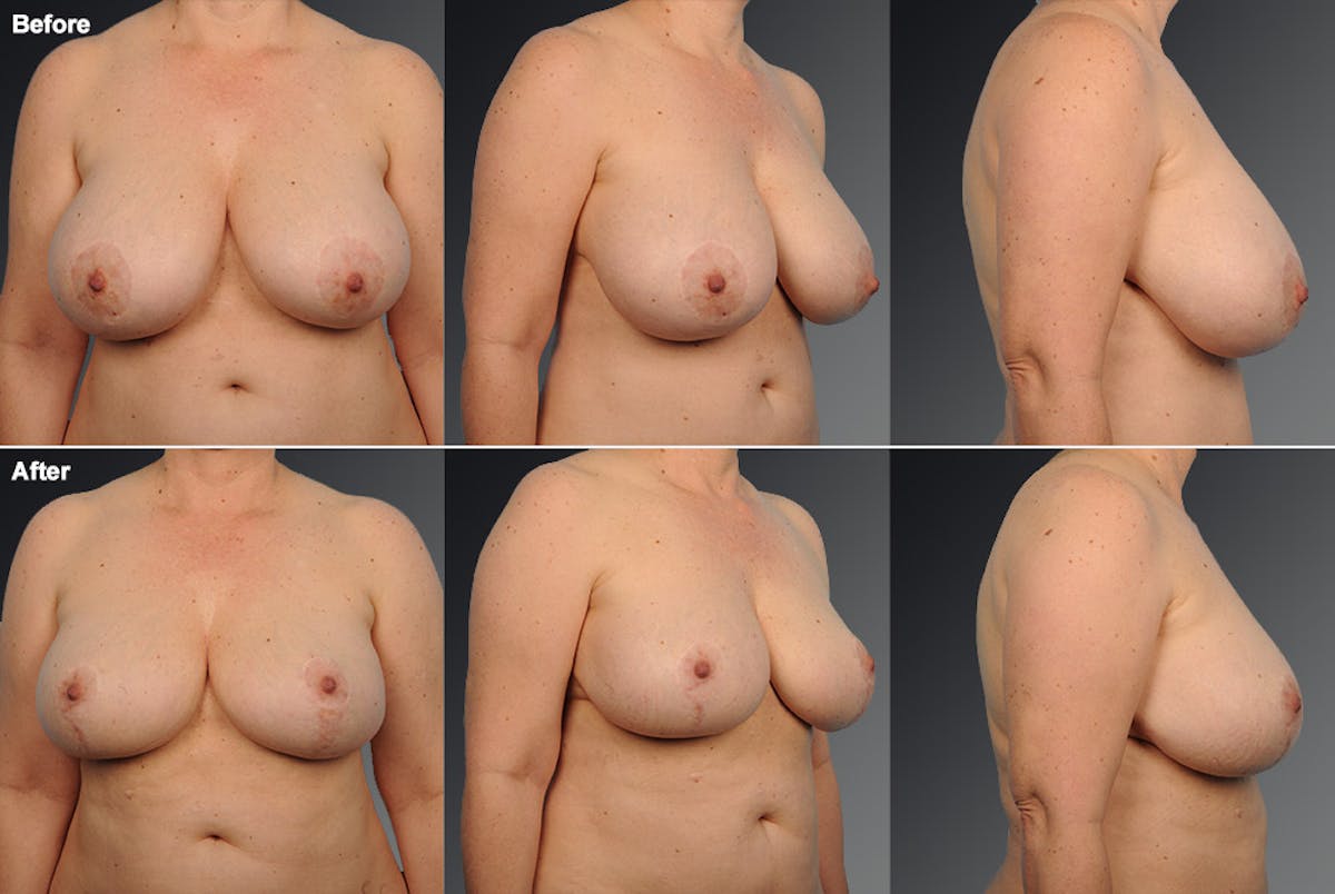Breast Lift (Mastopexy) Before & After Gallery - Patient 106358498 - Image 1