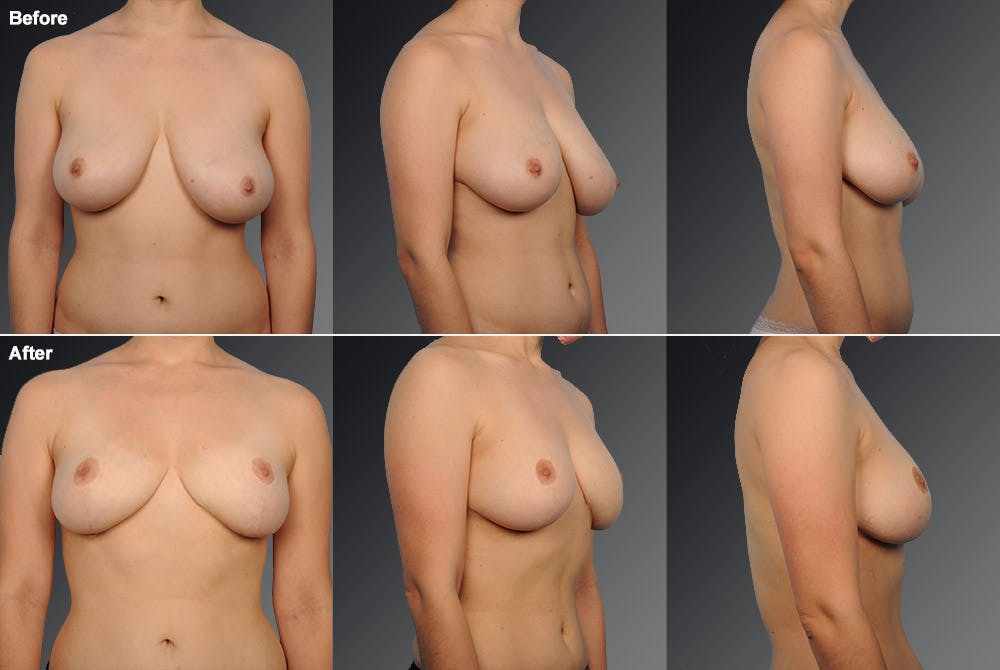 Breast Lift (Mastopexy) Before & After Gallery - Patient 106358499 - Image 1